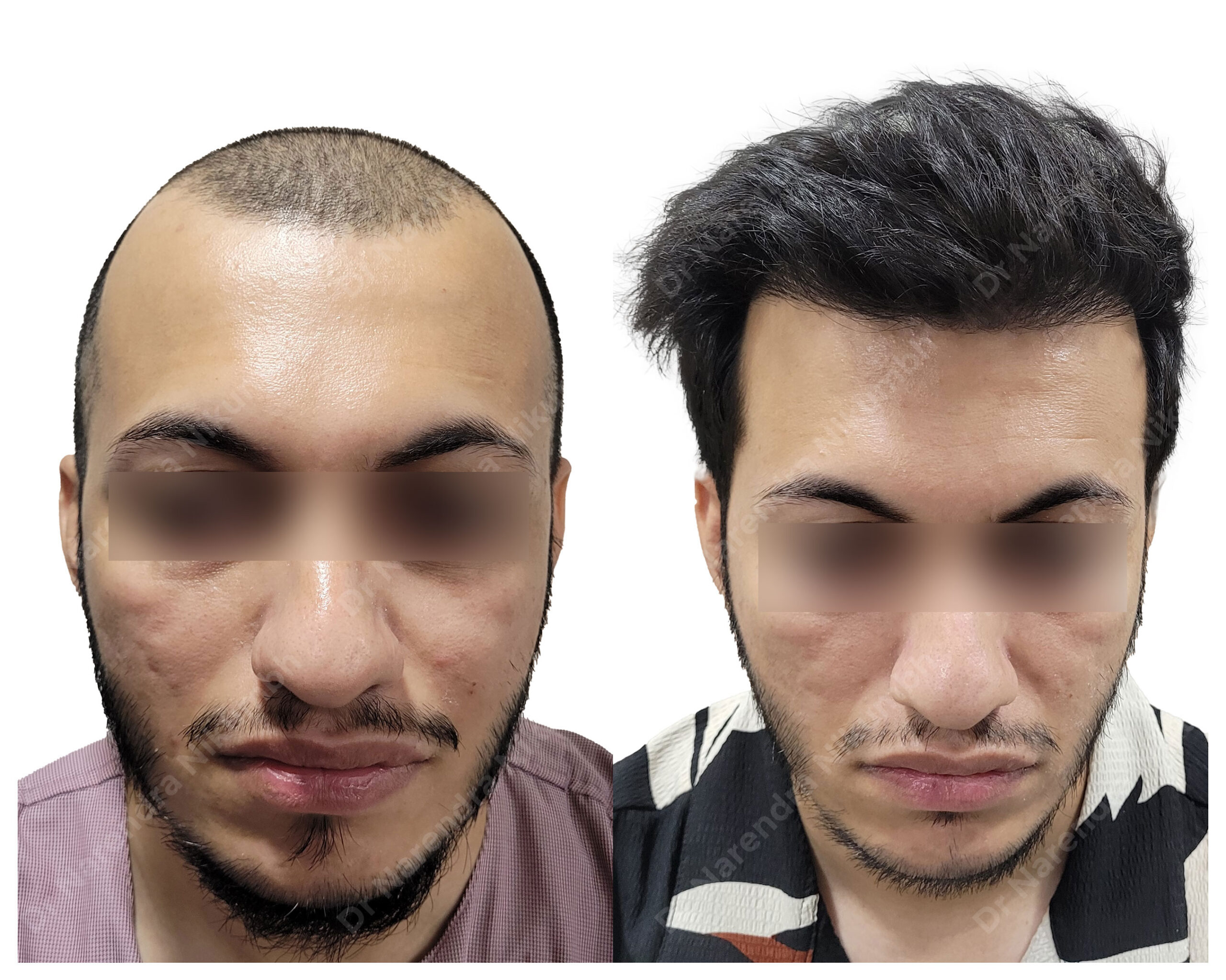 Chetan-Nayak-B&A-Masked