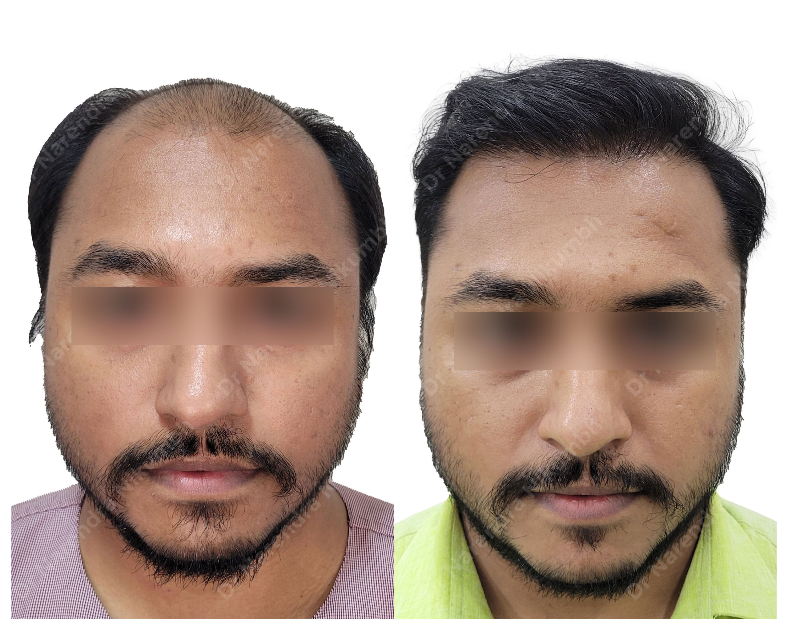 Kiran-Kapadi-B&A-Masked