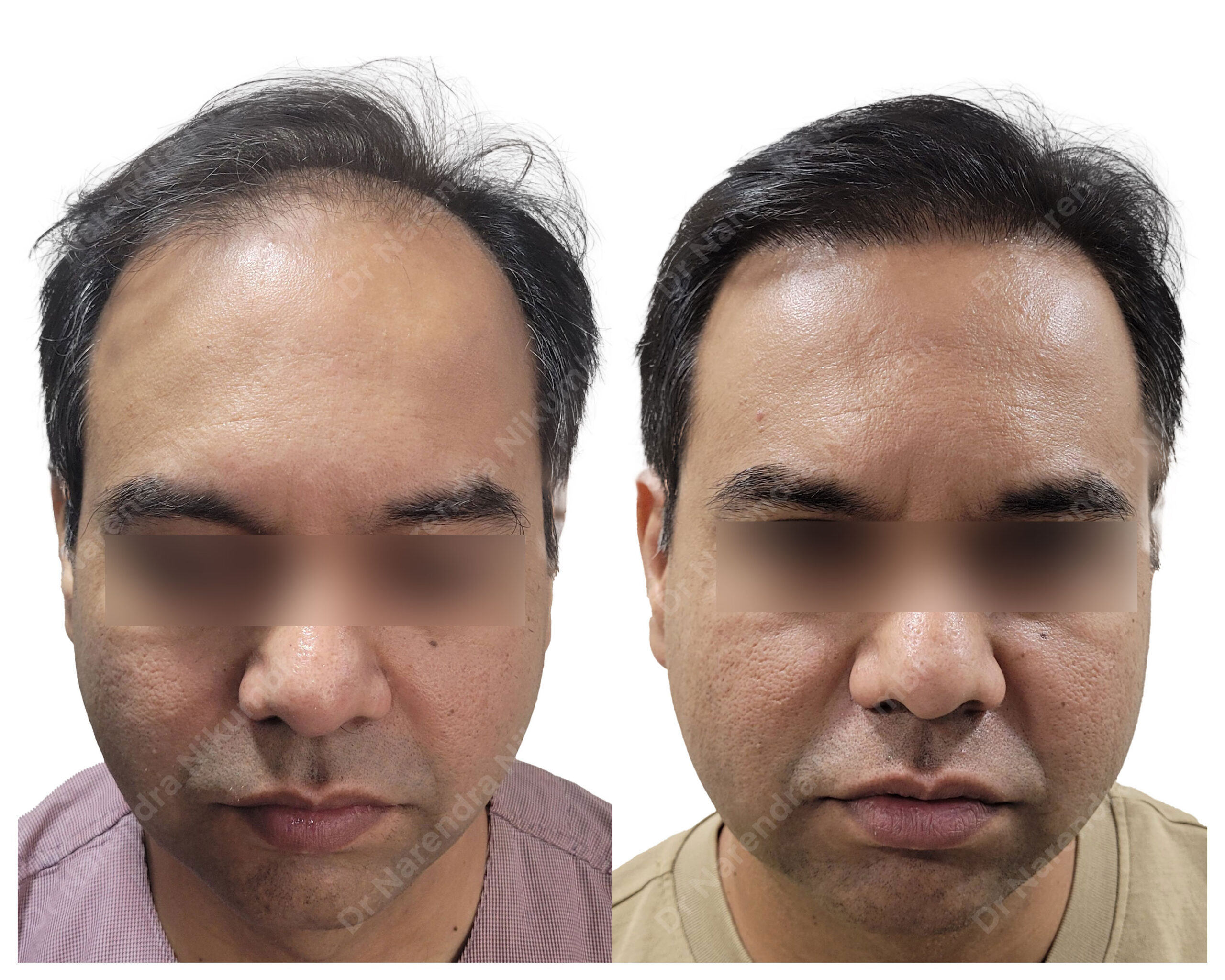 Kshitij-Bhusari-B&A-Masked