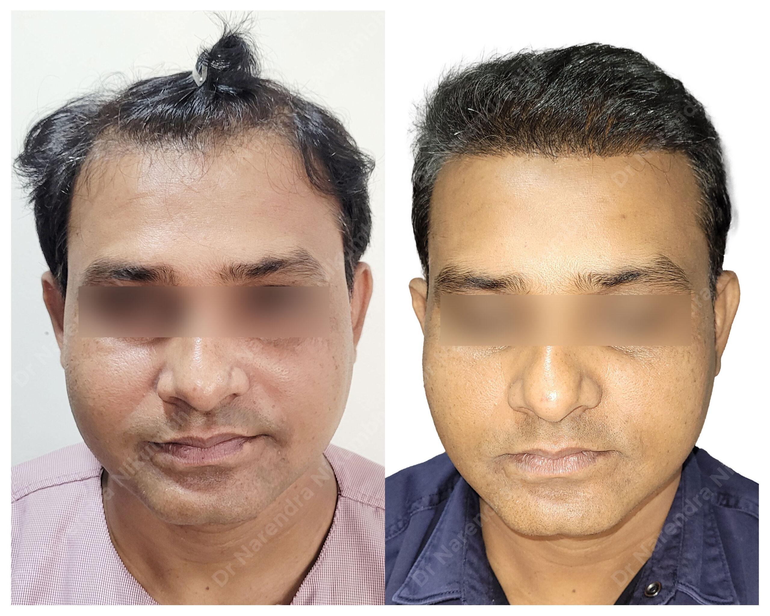 Manoj-Dhingian-B&A-Masked