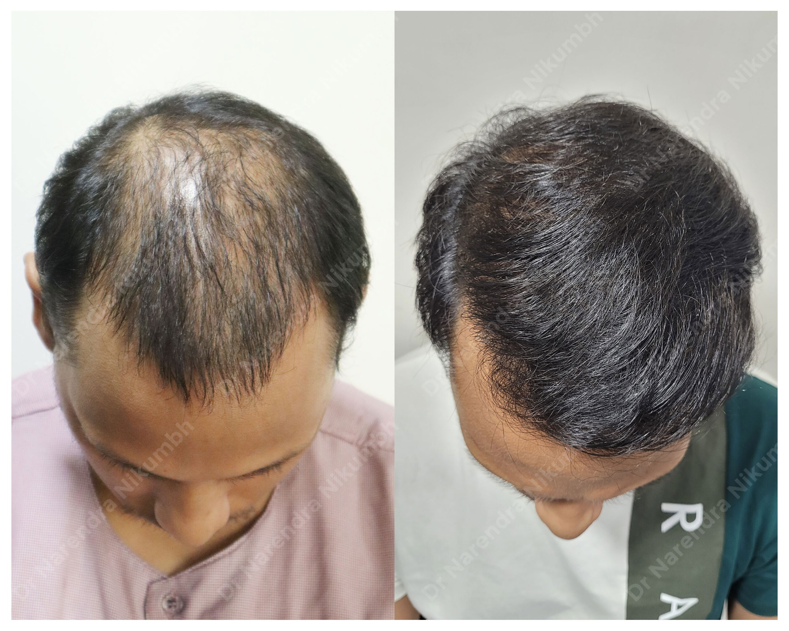 Prince-Dhingian--Down-B&A-Masked