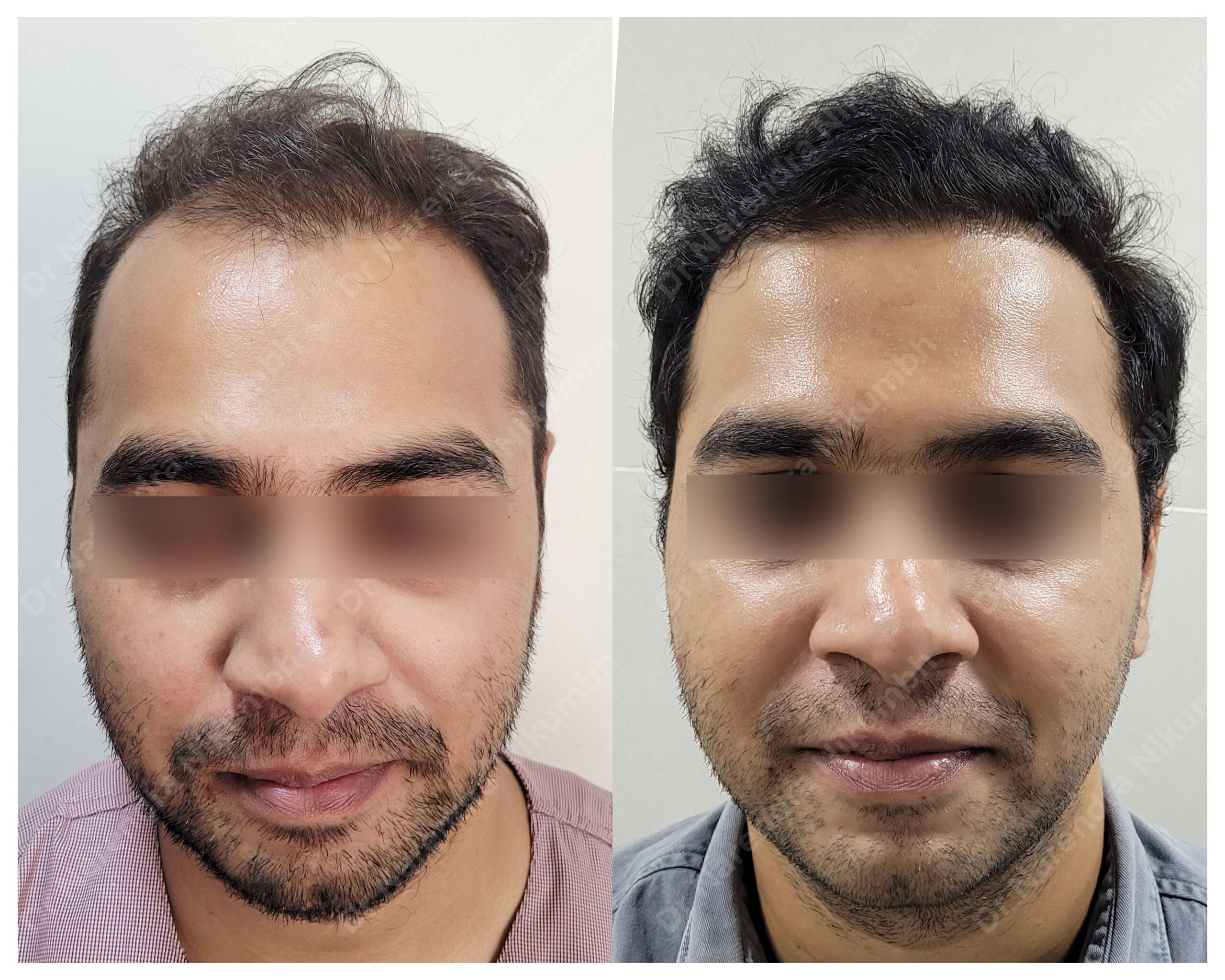 Rohit-Suryawanshi-B&A-Masked