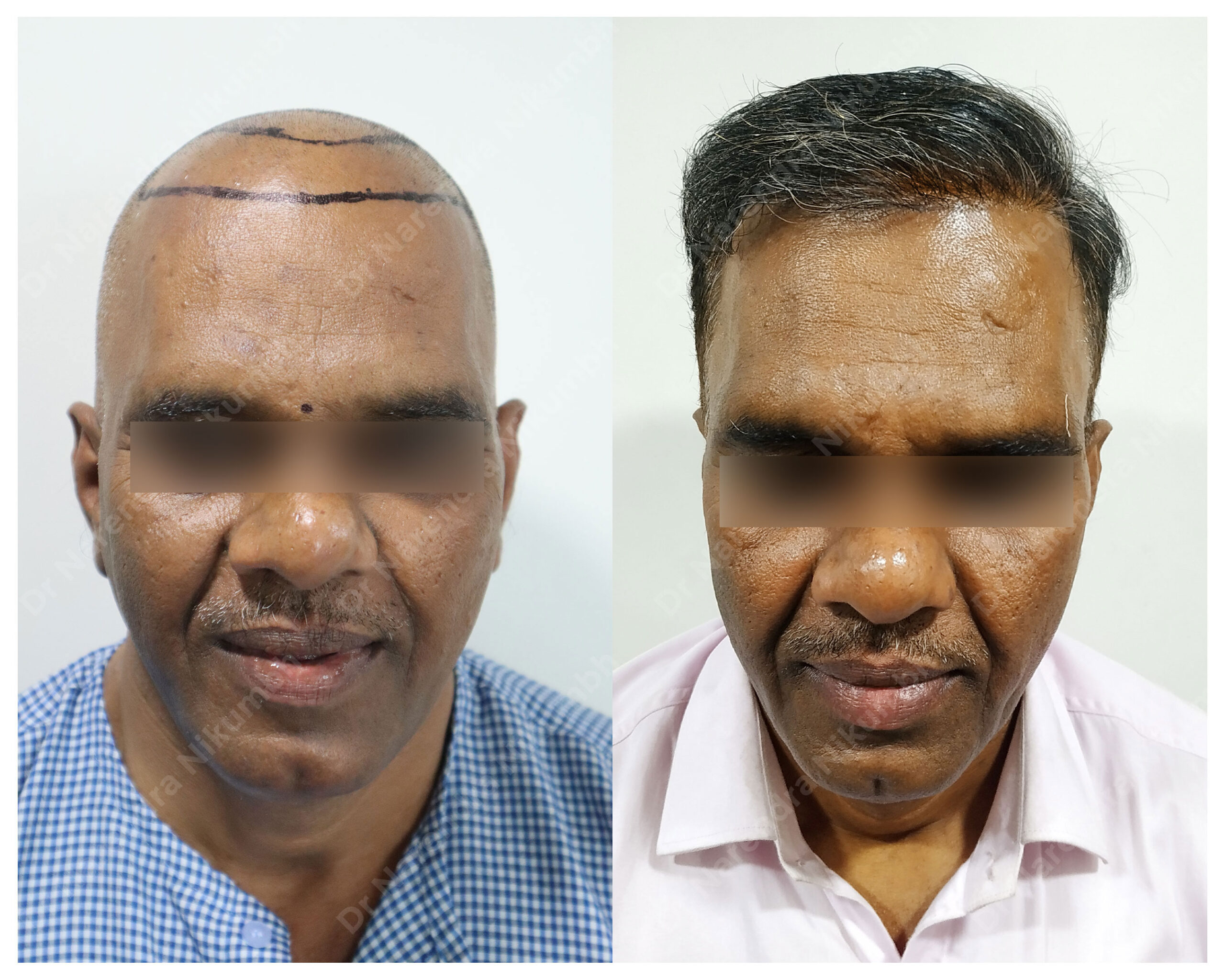 Shashikant-Berde-B&A-Masked